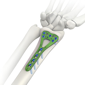 Multi-axial Locking Plate Pure Titanium Distal Radius